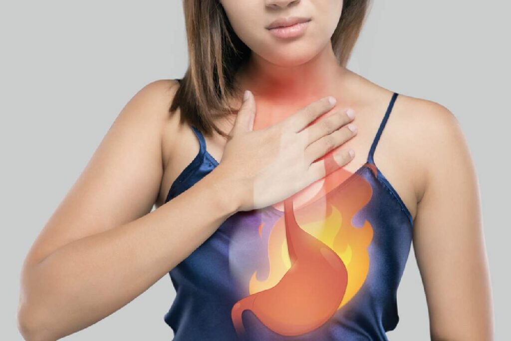How Heartburn And Gastroesophageal Reflux Occur Open Popup Dialog