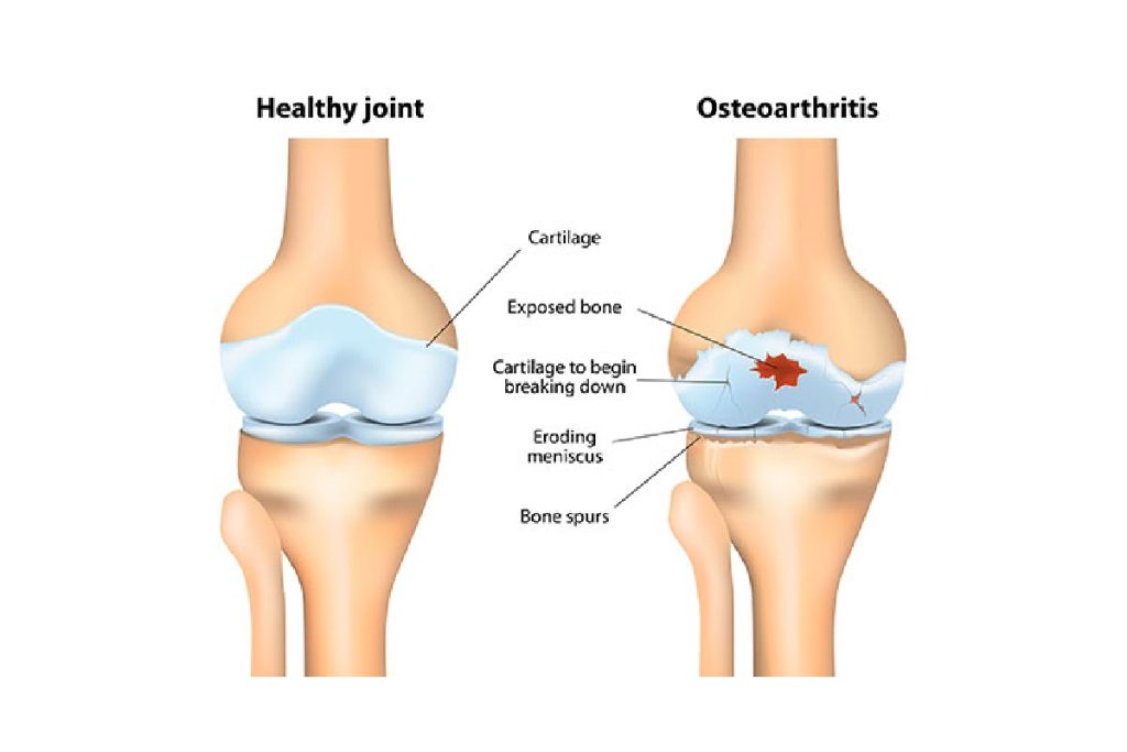 How to Improve Your Joint Cartilage Flexibility with Cartiflex