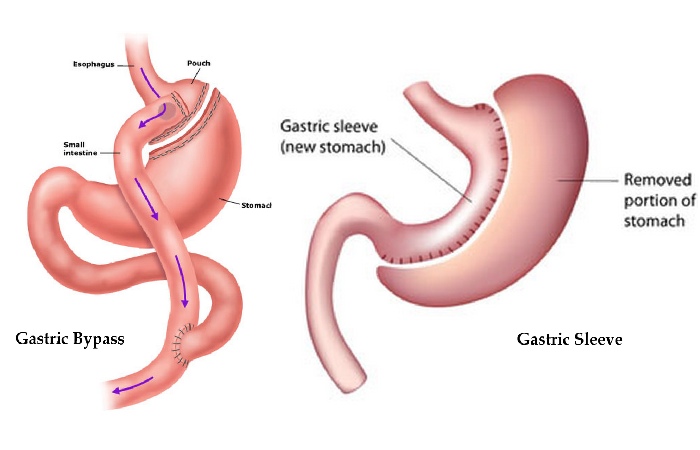 Gastric Sleeve Write For Us
