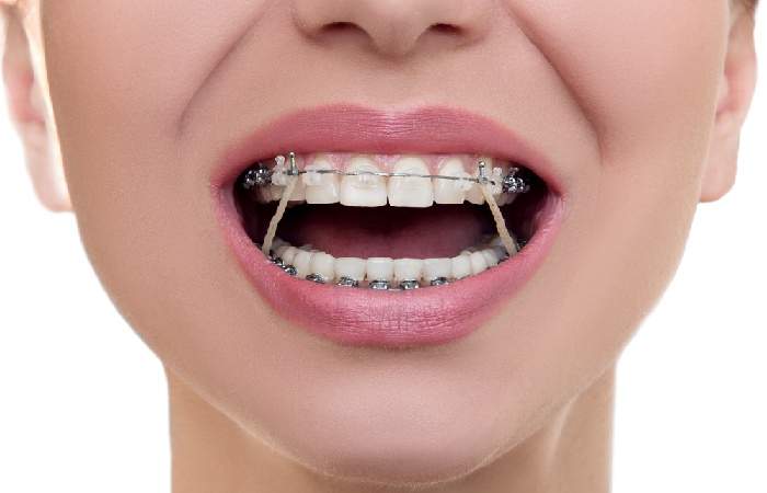 What is Invisalign Elastics?