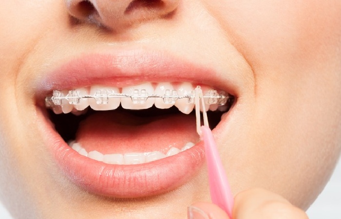 Do Elastics Really Work With Invisalign?