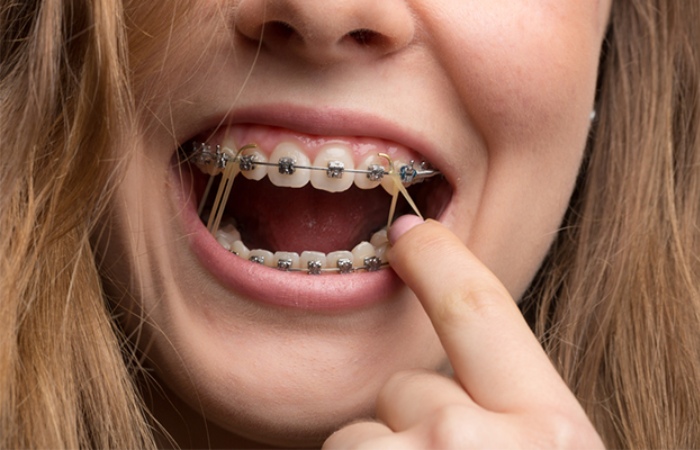 Invisalign Elastics Where To Buy