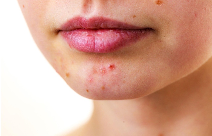 About Acne