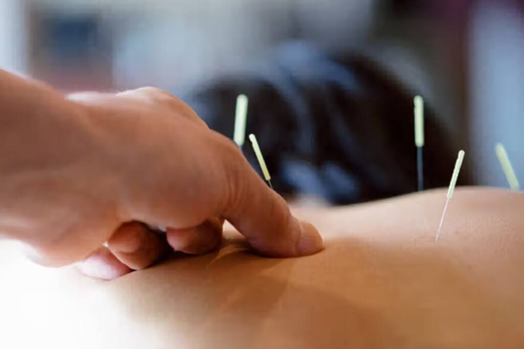 Does Acupuncture Really Work For Weight Loss? 2023