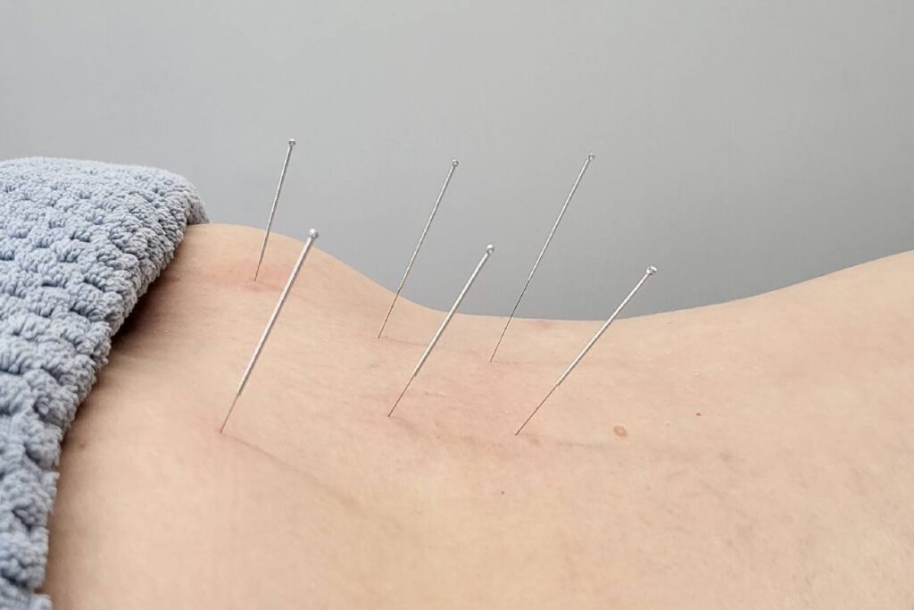 Dry Needling