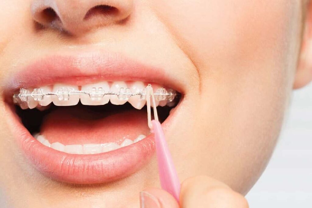 What To Know About Invisalign Elastics Before Your Appointment