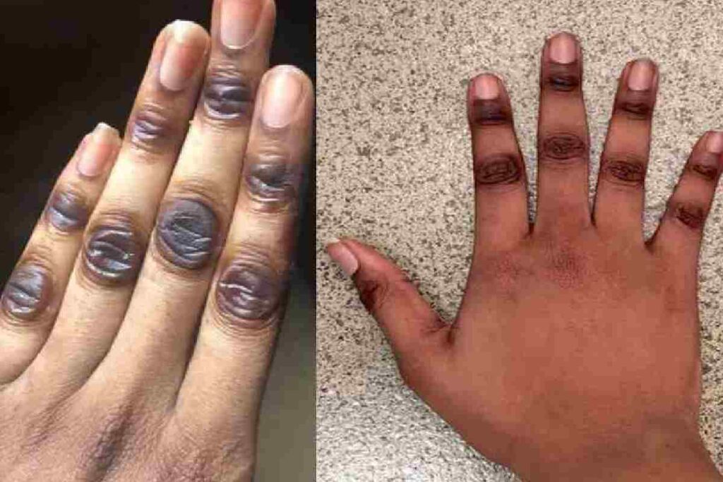 Lightening Remedies - The Best Beauty Tips For Dark Knuckles