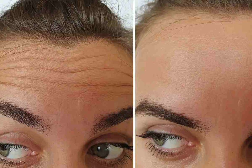 How to Reduce Wrinkles Naturally Without Surgery