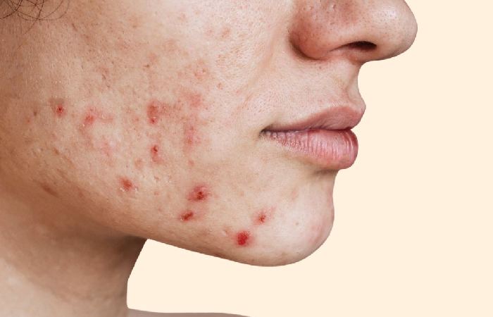 Acne Write For Us