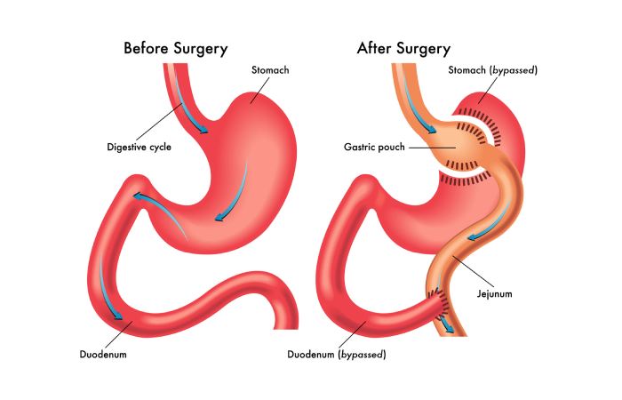 Gastric Sleeve Write For Us