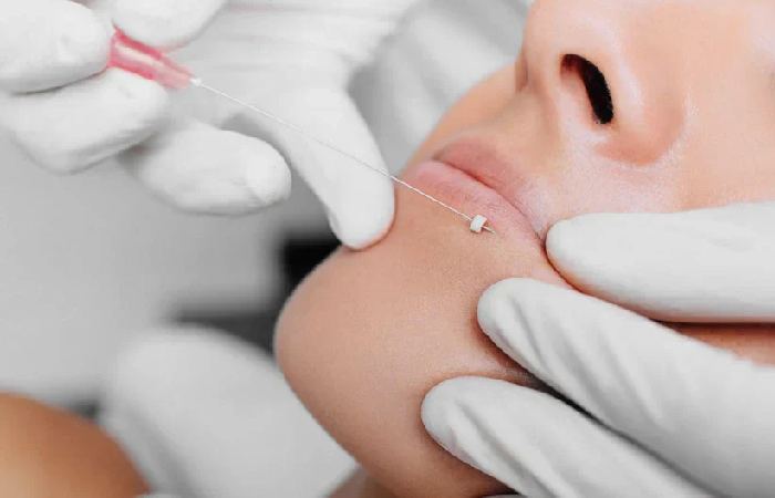 Ideal Candidates for Lip Threading