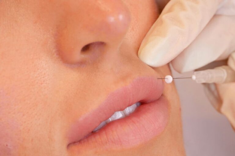 Lip thread