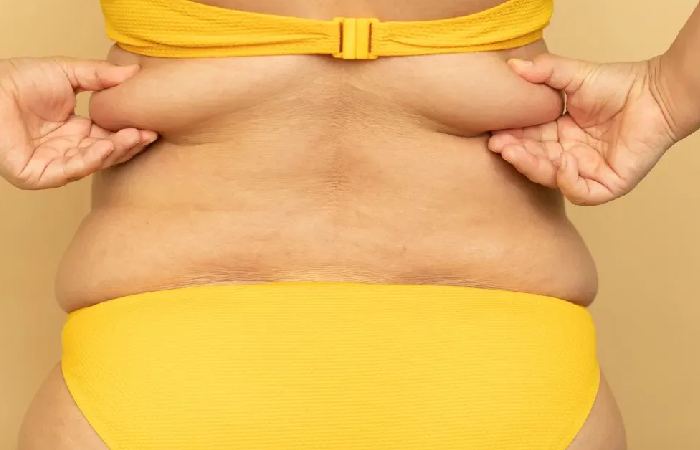 The Role of Hormones in Belly Fat Storage