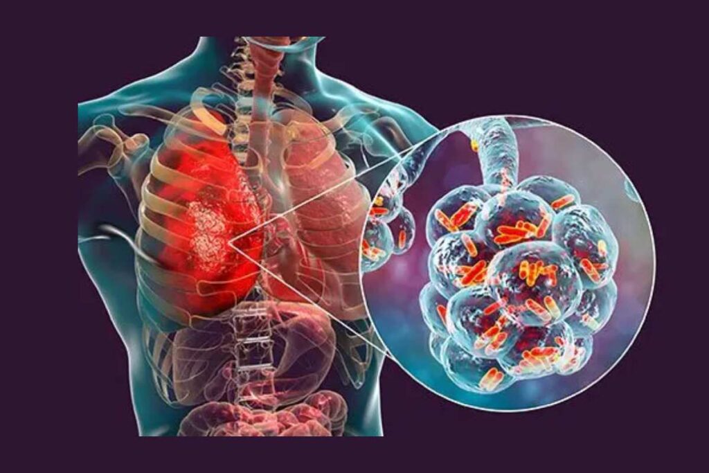 When Is Pneumonia Contagious, And How Is It Spread? pneumonia
